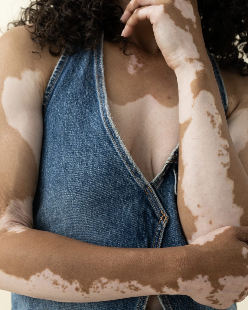 A woman standing with her arms folded, wearing a denim halter top, her skin patterned with lighter and deeper tones